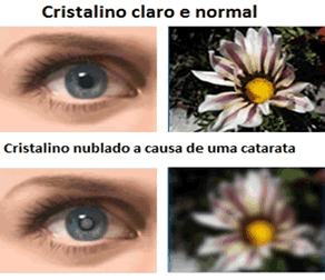 Olho normal comparado a olho com catarata