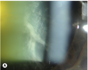 catarata cortical