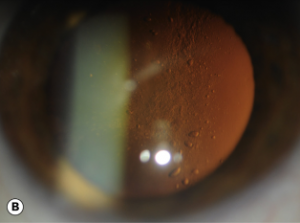 catarata subcapsular