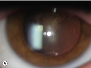 catarata subcapsular