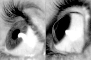 cornea com ceratocone
