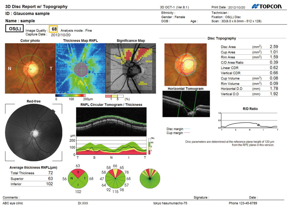 mapeamento de retina com OCT