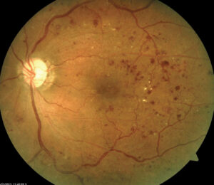 Retinopatia Diabética