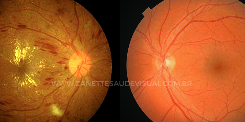 O que é retinopatia